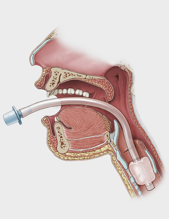 Une image qui démontre ce qu'est l'intubation par la bouche
